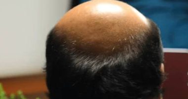 Una mujer acusa a su esposo de engaño matrimonial por ocultar uso de peluca – La Voz del Altiplano