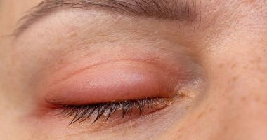 Ojos hinchados: causas y soluciones efectivas – La Voz del Altiplano