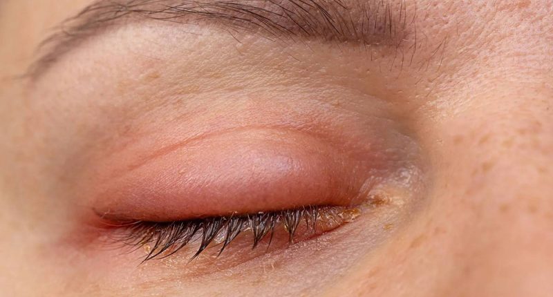 Ojos hinchados: causas y soluciones efectivas – La Voz del Altiplano