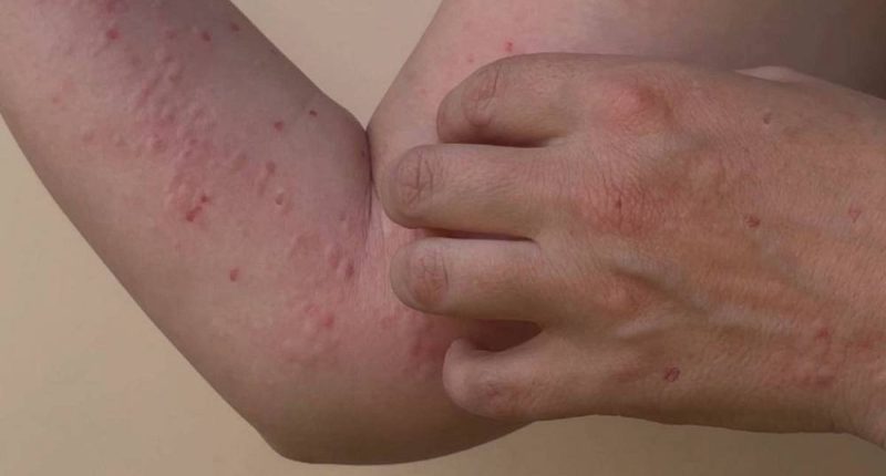 Ecuador reporta primer caso importado de viruela símica – La Voz del Altiplano