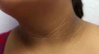 ¿Tienes oscuro tu cuello, axilas y entrepiernas? Esto puede ser señal de esta enfermedad – La Voz del Altiplano