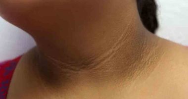 ¿Tienes oscuro tu cuello, axilas y entrepiernas? Esto puede ser señal de esta enfermedad – La Voz del Altiplano